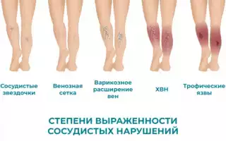 Острая и хроническая венозная недостаточность нижних конечностей: различия в симптомах и лечение