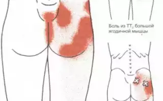 Ягодица болит и отдает в ногу: ищем источник проблемы