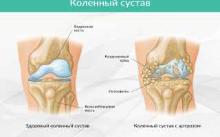 Остеофиты коленного сустава: как лечить и что это такое
