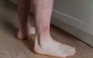 Устранение гусиной кожи на ногах