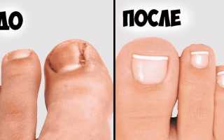 Как определить вросший ноготь на ноге и что делать