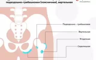 Основные симптомы бурсита тазобедренного сустава