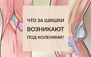 Почему под коленом сзади появляется шишка?
