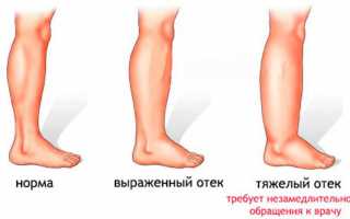 Если к вечеру отекают и гудят ноги