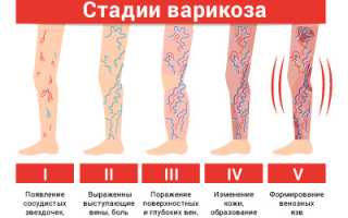 Лечение и признаки варикоза вен на ногах
