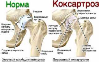Явные симптомы коксартроза тазобедренного сустава и его лечение