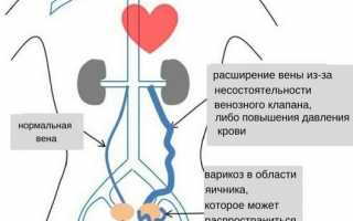 Диагностика и лечение варикозного расширения вен малого таза у женщин