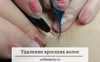 Как удалить вросшие волосы, если они на ногах?