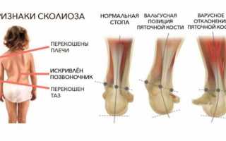 О варусной деформации стопы у взрослых и детей