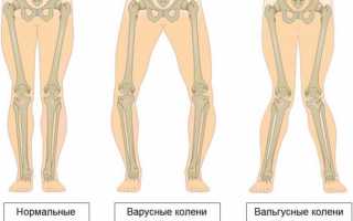 Вальгусная и варусная деформации голени