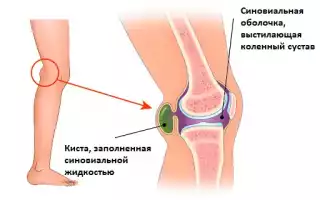 При сгибании и разгибании болит колено: что это значит?