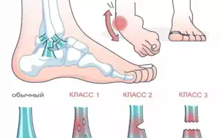 Признаки и лечение разрыва связок голеностопного сустава