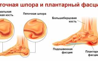 При ходьбе болит пятка и больно наступать: в чем причина?