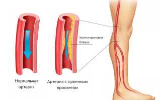 Стенозирующий атеросклероз: когда поражены сосуды нижних конечностей