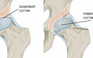 Последствия и лечение остеоартроза тазобедренного сустава