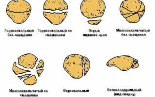 Виды перелома коленной чашечки и методы лечения