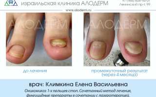 Грибок ногтя в запущенной форме: лечение и диагностика