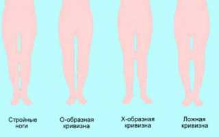 Причины кривых ног и их коррекция
