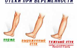 Сильно отекают и опухают ноги при беременности: что с этим делать?