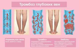 Симптомы и лечение тромбоза глубоких вен нижних конечностей