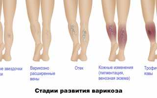 Природа клапанной недостаточности вен нижних конечностей