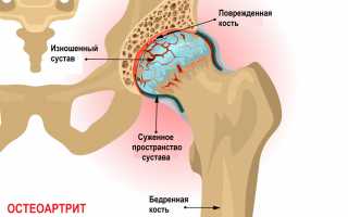 Почему при ходьбе возникает боль в тазобедренном суставе и что делать?