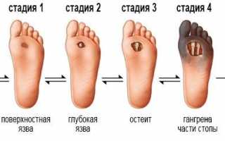 Виды и признаки гангрены ноги