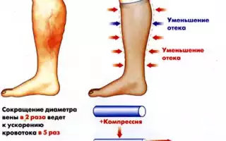 Насколько реально лечение лимфостаза нижних конечностей в домашних условиях
