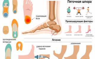 Патологическое изменение стопы: пяточная шпора