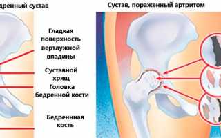 Первичные симптомы артрита тазобедренного сустава и его лечение