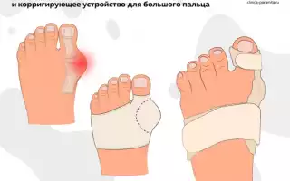 Своевременная помощь при артрозе большого пальца ноги