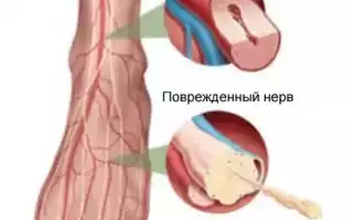 Появление мурашек в ногах: причины