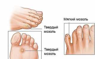 Наиболее распространенные кожные заболевания на ногах