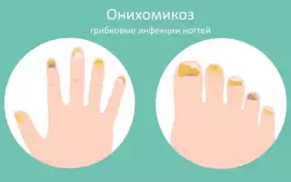 Чем эффективно лечить грибок ногтей на ногах в домашних условиях?
