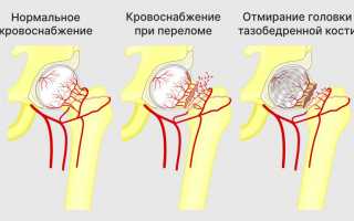 Причины и последствия перелома шейки бедра