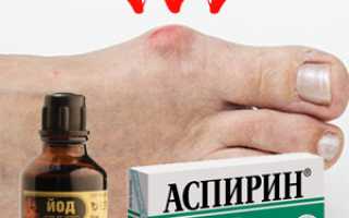 Способы лечения подагры йодом