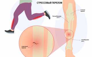 Каковы симптомы трещины в кости на ноге?