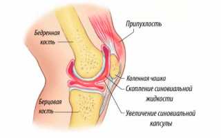 Жидкость в коленном суставе: возможные причины и лечение