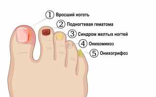 Причины желтых ногтей на ногах