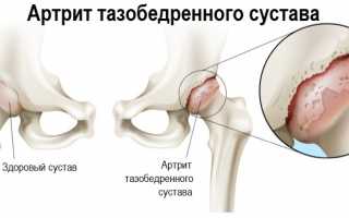 Мучительно болит нога в паху: что это может быть?