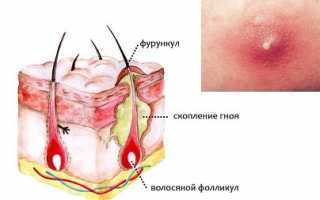 Как бороться с чирьем на ноге и каковы основные причины его появления