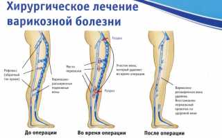 Устранение варикозного расширения вен на ногах посредством операции