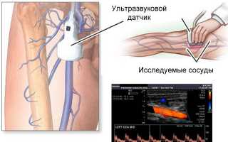 Проведение УЗДГ сосудов нижних конечностей: что это такое