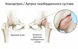О применении хондропротекторов при коксартрозе тазобедренного сустава