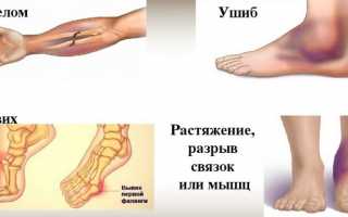 Диагностика и лечение ушиба стопы