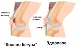 Почему могут болеть колени?
