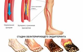 Механизм развития облитерирующего эндартериита сосудов нижних конечностей