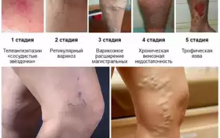 Лечение заболевания: ретикулярный варикоз — что это такое