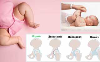 Как корректировать дисплазию тазобедренных суставов у детей