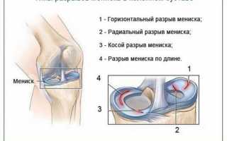 Диагностика и лечение разрыва мениска коленного сустава